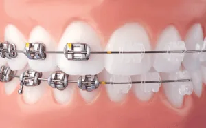 What do clear braces look like versus metal braces at NCOSO