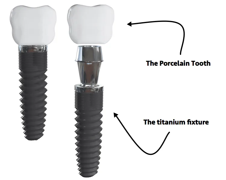Anatomy of a Dental Implant
