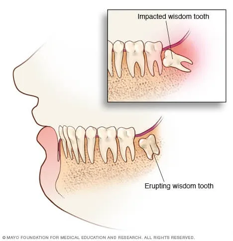 Mayo Clinic impacted Wisdom teeth illustration