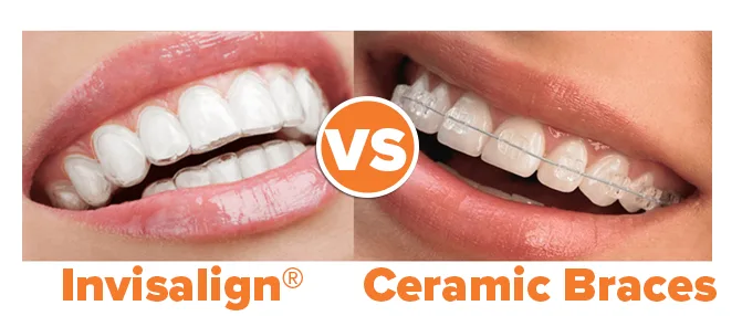 Invisalign versus Ceramic Clear Braces photo