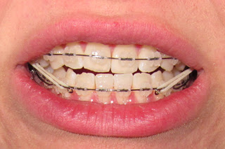 Beginning of clear braces treatment