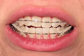 Beginning of clear braces treatment