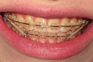 Stained ceramic braces after 1 year